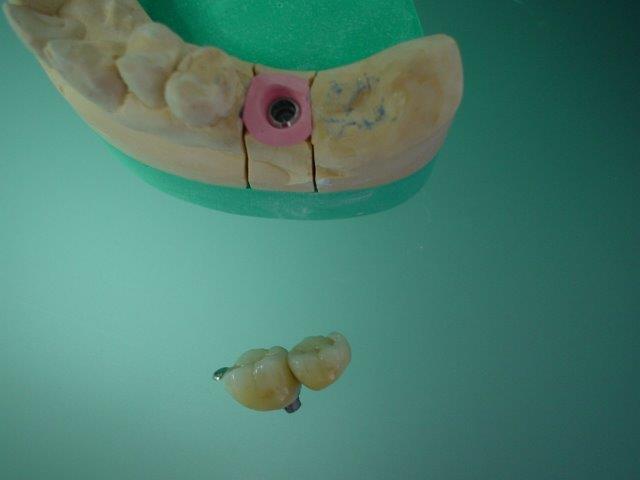 dentiste-bridge-belgique1 (2)