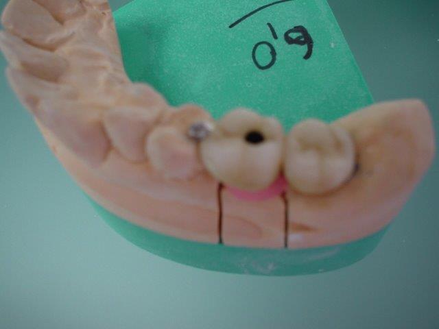 dentiste-bridge-belgique1 (3)