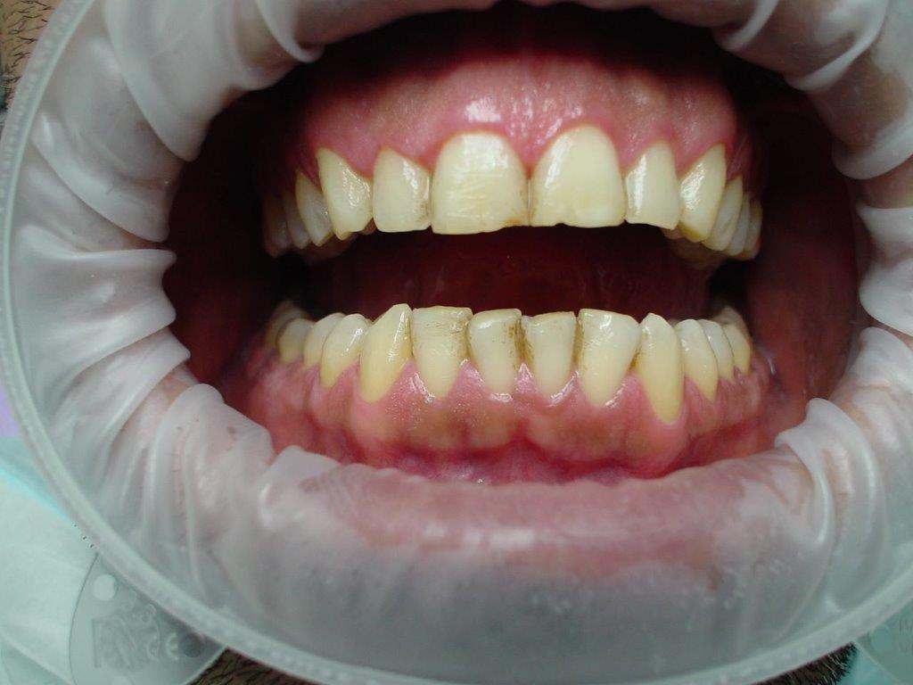 detartrage-dentiste-belgique (2)