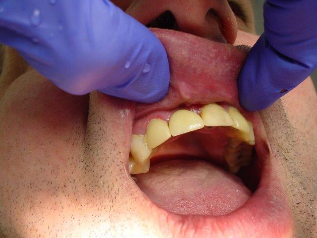 implants-dentiste-belgique1 (8)