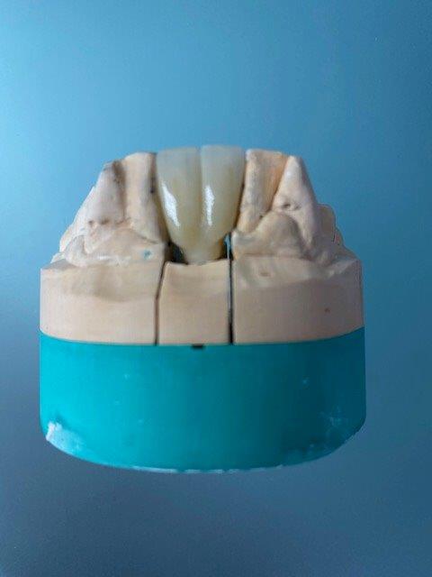 alternative de remplacement dentaire esth sur implants 3