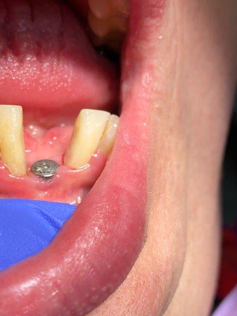 alternative de remplacement dentaire esth sur implants 5