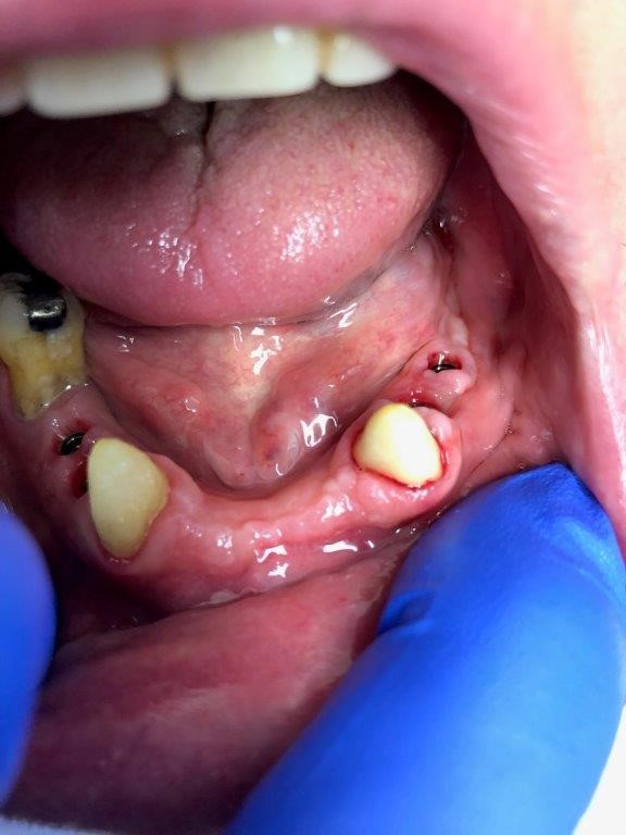 dentiste-hossay-implant-belgique (5)