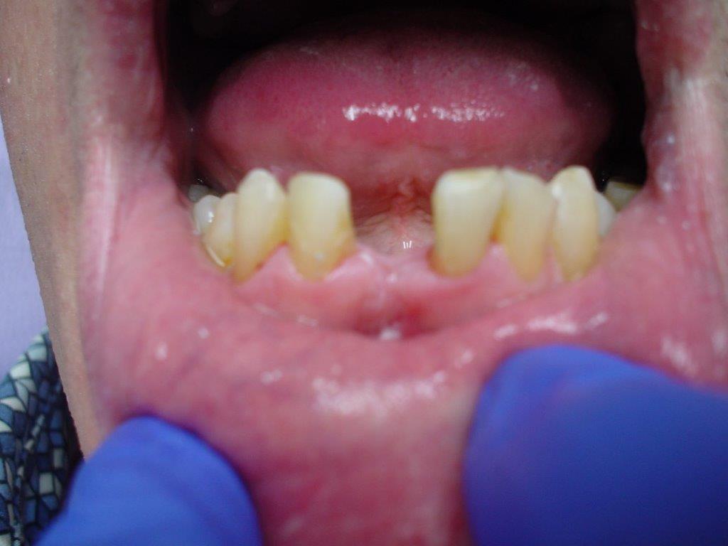 dentiste-hossay-solution-alternative-implant (5)