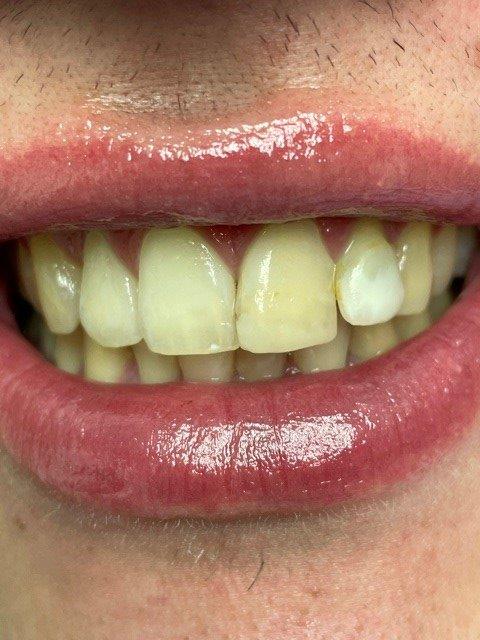 dentiste-hossay-soins-esthetique (3)