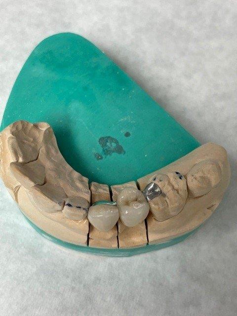 hossay-dentiste-reconstruction-prothetique (1)