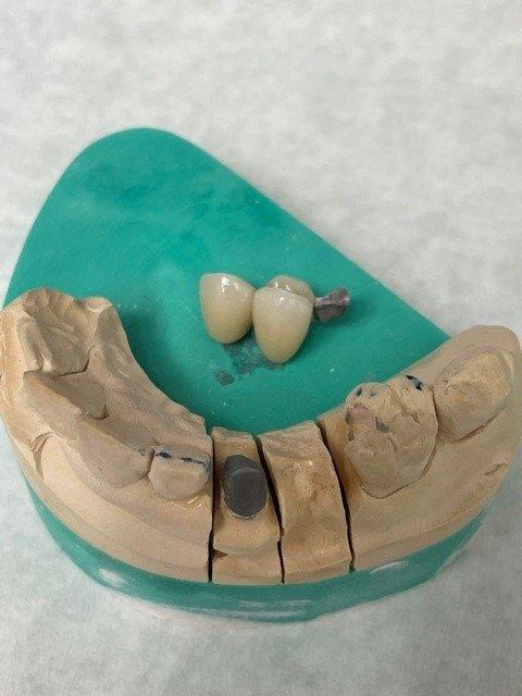 hossay-dentiste-reconstruction-prothetique (2)