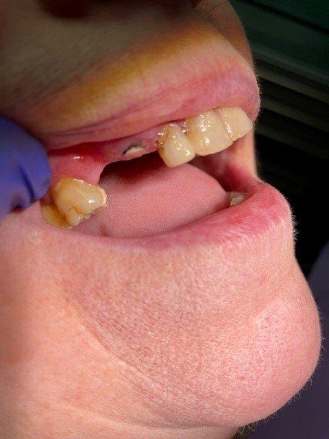 hossay-dentiste-reconstruction-prothetique (3)